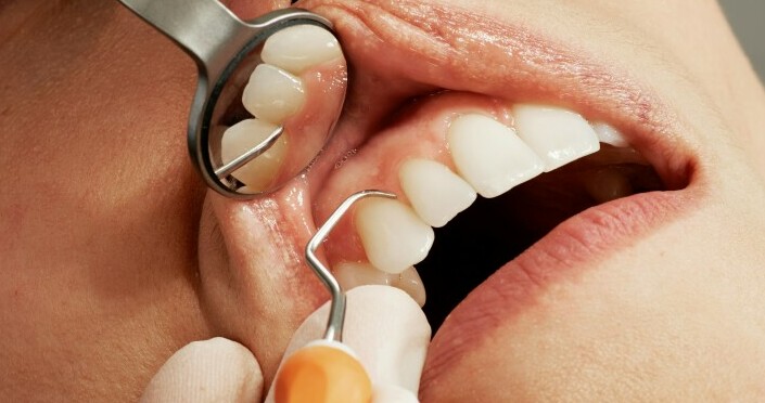 gum disease and teeth