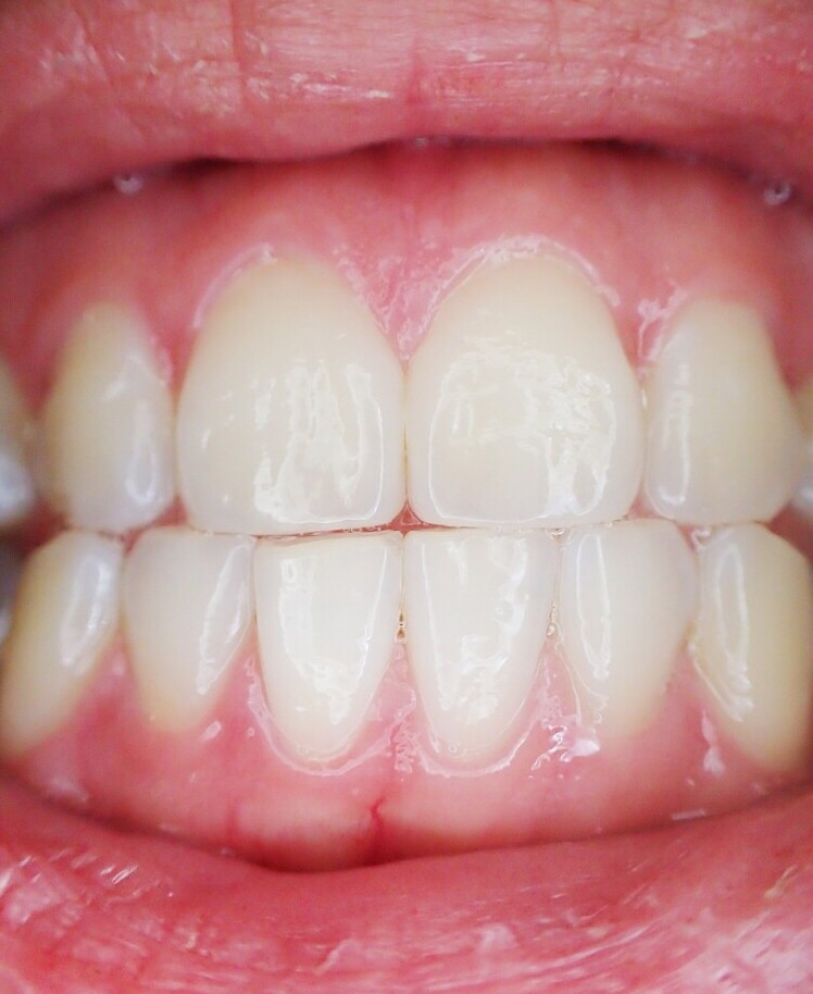 Healthy teeth and gums